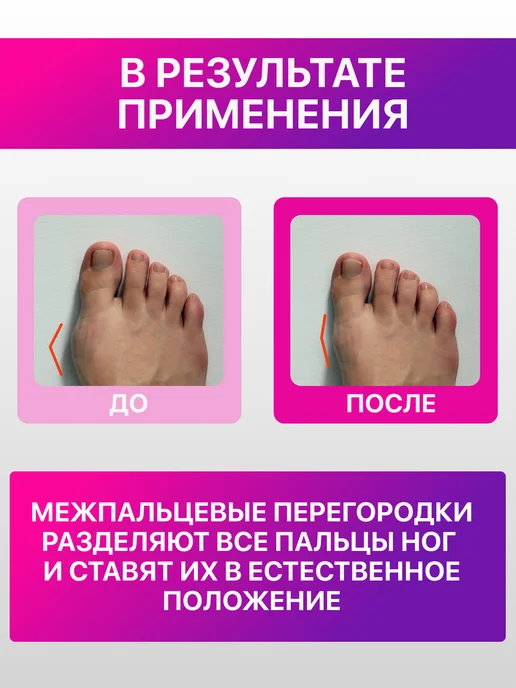 OrtopedPRO+ Ортопедические межпальцевые разделители для пальцев ног 4 шт, 4 шт, фото 3